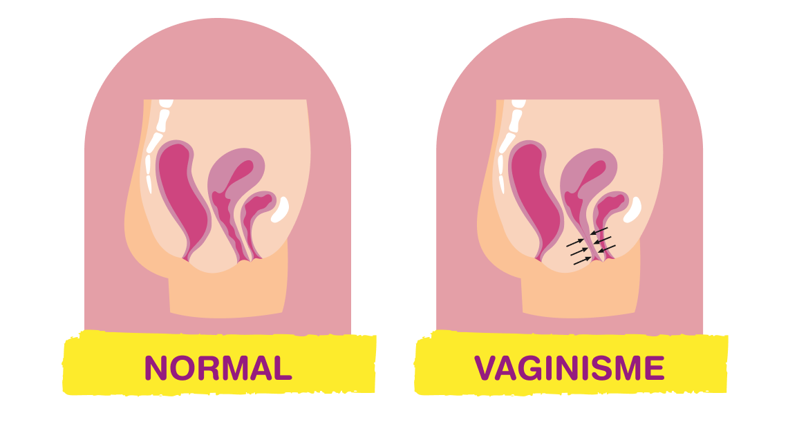 Schéma comparatif anatomie normale et vaginisme, illustration article LMDE sur les causes et symptômes du vaginisme